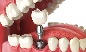 Dental Implants